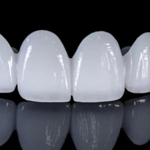 Snap-On Veneers Full Set von Celebrities Secret – maßgefertigte Veneers für Ober- und Unterkiefer