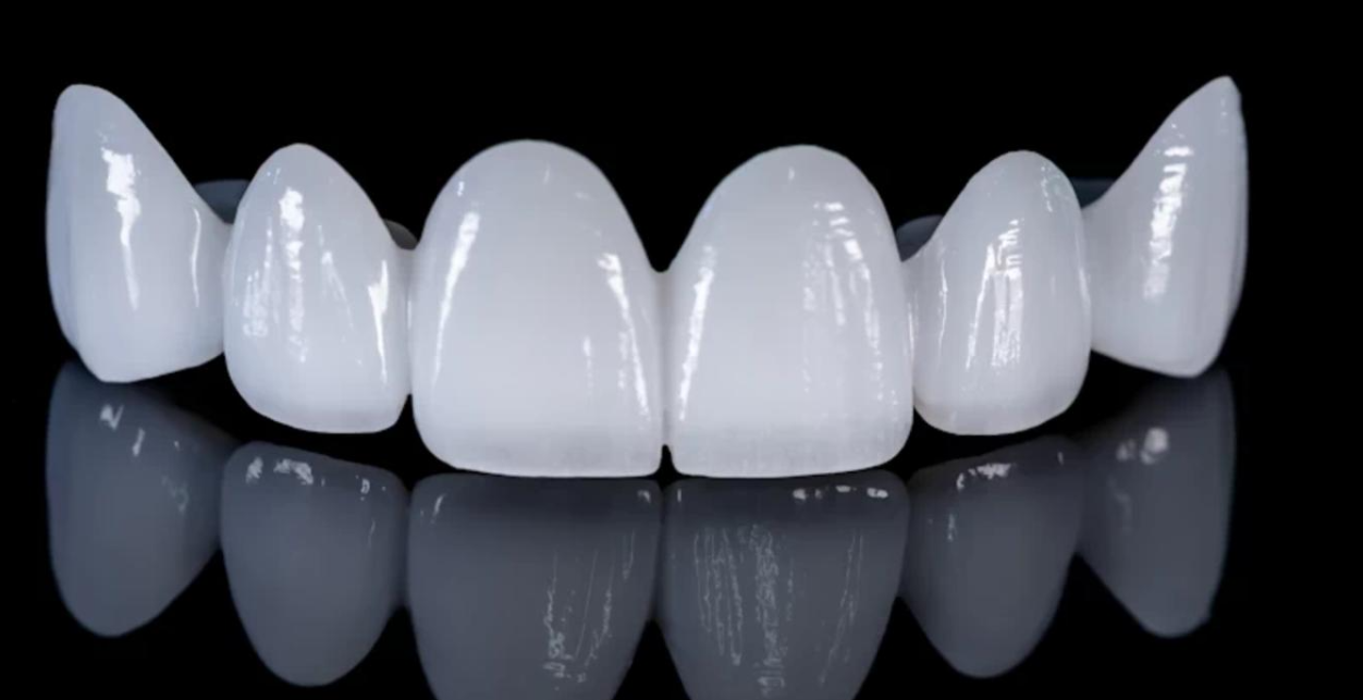 Snap-On Veneers Full Set von Celebrities Secret - massgeschneiderte Veneers fuer Ober- und Unterkiefer