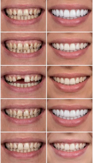 Snap-On Veneers Vorher Nachher Vergleich - Celebrities Secret Ergebnis